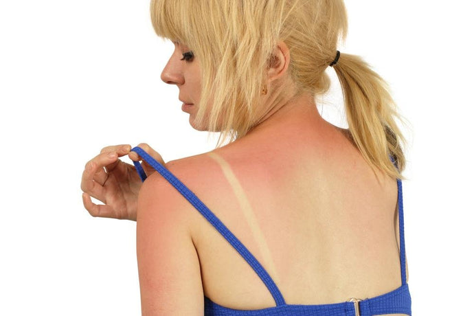Sunburn Relief: The Best Sunburn Relief Tips & Treatment