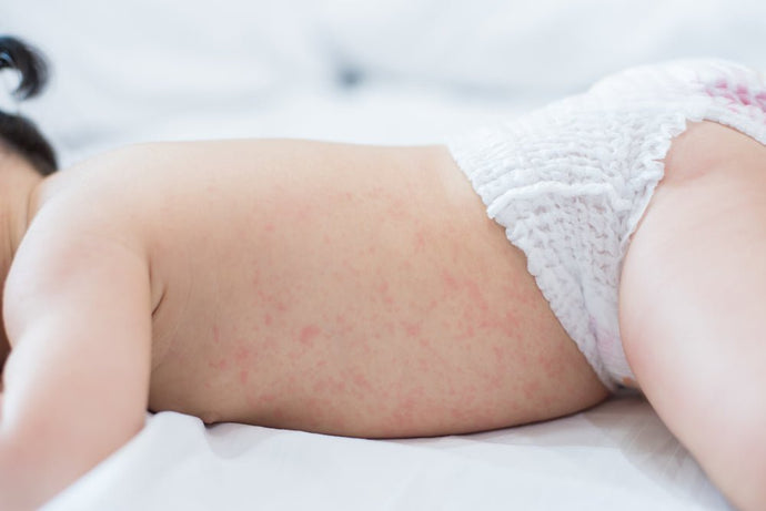 Baby Heat Rash: Symptoms, Prevention & Treatment