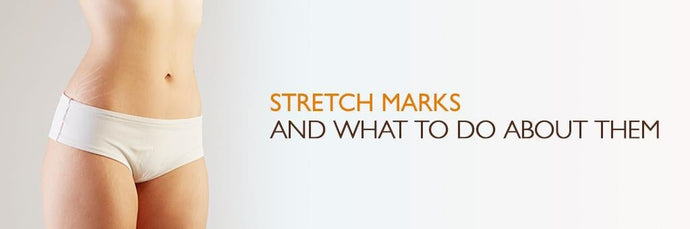 How To Prevent And Reduce The Appearance Of Stretch Marks: Expert Tips